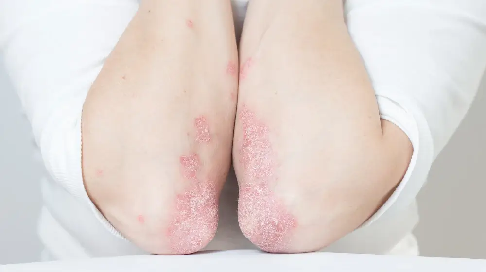 La fototerapia PUVA para el tratamiento de la psoriasis 4 fototerapia psoriasis